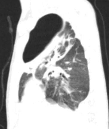 Figure 5: 3 months of age patient’s CT scan. Right-sided pneumo thorax. Bronchopleural fistula After preoperative management and stabilizing patient’s condition, right-sided thoracocentesis was performed. After 10 days bronchoscopy, bronchial lavage and temporary bronchial occlusion was done. Occludor was removed after 10 days. On x-ray control: absence of free air in pleural cavity. Complete expansion of the pleural cavity (Figure 6).