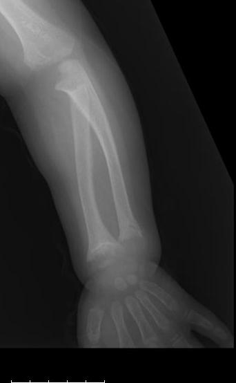 Figure 1: rickets signs: wrists/hands radiographs.