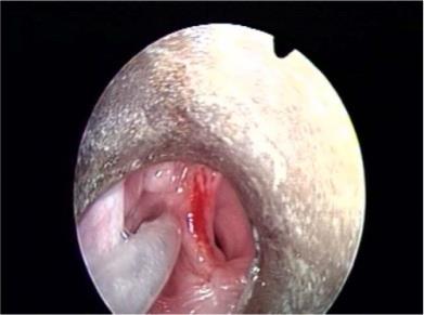 Figure 1: X ray soft tissue neck lateral view showing the radio opaque foreign body lodged at the level of cricopharynx.