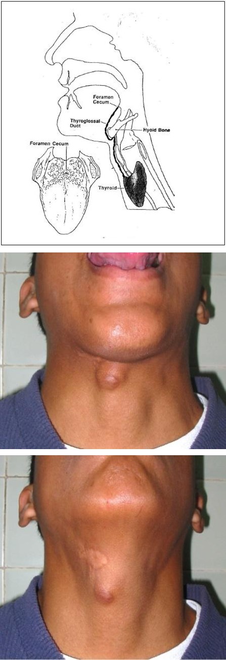 Figure 1: Embryological origin of the thyroid.