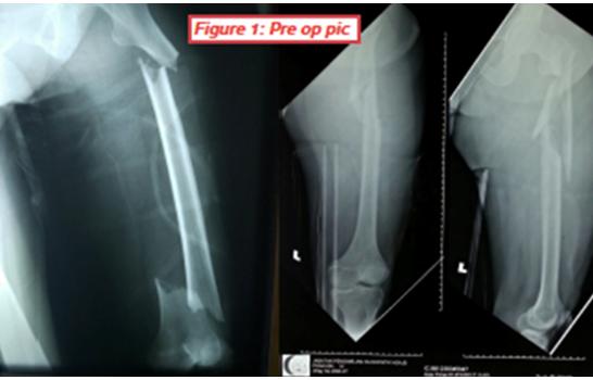 Figure 1: Pre op pic.