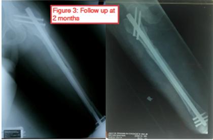 Figure 3: Follow up at 2months.