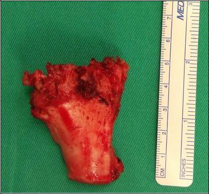 Figure 4: Post Excision of Heterotopic ossification.