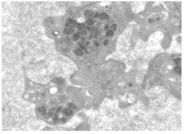 Figure 1: The results of non-AAS platelet aggregation of the group whose blood samples were studied under the electron microscope.
