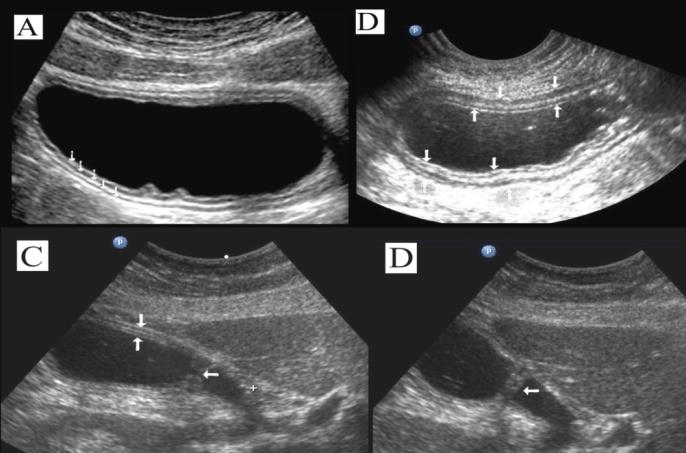 Figure 1: Ultrasonogram of the stomach for various projections of scanning and degree of filling. A: The arrows show all layers of the stomach wall at the body level in the transverse section. B: Partial emptying of the stomach, all layers of the wall is clearly differentiate. С: The vertical arrows show the anterior wall of the antrum, the horizontal arrows – pyloric, which is not fully open. D: The same, pyloric is closed. To diagnose distal stomach cancer and assess the degree of stenosis, the following echographic symptoms were used: 1. Presence of parietal formations protruding into the cavity of the stomach outside peristaltic waves. 2. Deterioration or absence of differentiation of the layers of the stomach wall. 3. Local thickening of the stomach wall more than 6 mm. 4. Local reduction or absence of peristaltic waves.