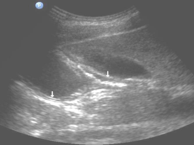 Figure 2: The gastric carcinoma of diffuse form. An area with a local thickening up to 6 mm, a length of about 15 mm, is visualized on the anterior wall of the antrum (upper arrow). Mucous, muscular and serous membranes are differentiated. The lower arrow shows a clear differentiation of all layers of the posterior wall of the intact antrum.