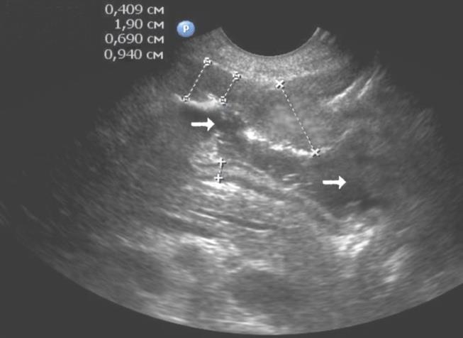 Figure 4: T3N2MO-visualization of gastric carcinoma of antrum ultrasonographycally. Decompensated pyloricstenosis. Identification of pyloric channel is difficult. It is visualized in the form of a narrow hyperechoic strip (horizontal arrows)