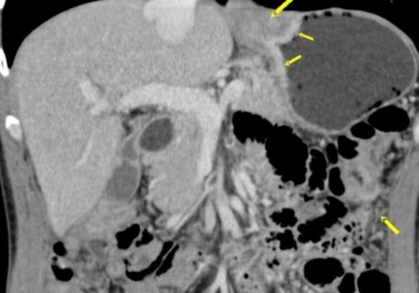 Figure 5: T3N2MO-visualization of gastric carcinoma of antrum with computer tomography. Decompensated pyloricstenosis. Pylorus is not identified.