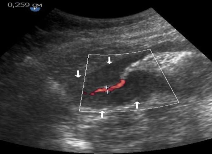Figure 6: T3N2MO - visualization of gastric carcinoma of antrum with computer tomography. Decompensated pyloric stenosis. At the time of passing the flow of the additionally drunk liquid in the upright position of the patient, the significantly narrowed pyloric canal is visualized as a color tubular structure with a width of 0.259 cm