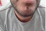 Figure 3: Cutaneous Cryptococcosis: Single nodules chin umbilicate with necrosis in the cenr before the start of antifungal treatment.