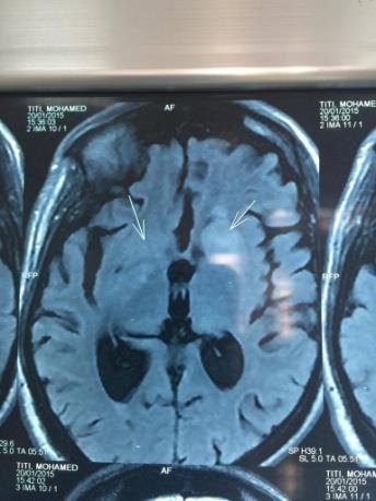 Figure 7: Cryptococcoma.