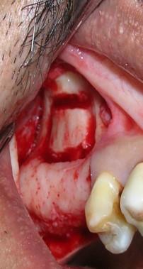 Figure 4: Outlining of buccal window.