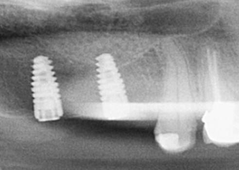 Figure 6: Placement of implants.