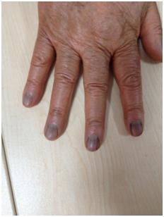 Figure 3: Transverse brownish-black pigmentation and longitudinal bands on multiple nails of hands.