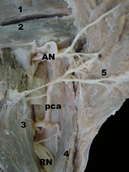 Figure 1: Posterior view of right shoulder shows the infraspinous (1) and teres minor muscle (2), under, axillary nerve (AN) is crossing the quadrilateral space. The posterior circumflex humeral artery (pca) goes close to the radial nerve (RN), outside the quadrilateral space, under the longus head of triceps brachii muscle (3) and medial to the lateral head of triceps brachii muscle (4) ending at the deep surface of the deltoid muscle (5).
