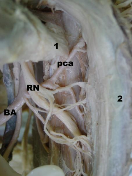 Figure 2: Posterior view of right shoulder. Teres major muscle is withdrawn (1) and the longus head of triceps brachii muscle is at the right side (2). Detail of the posterior circumflex humeral. artery (pca) arising in common with the profunda brachii artery from brachii artey (BA). Notice the close relation to the radial nerve (Rn).