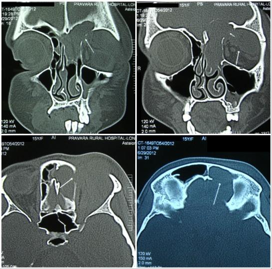 Figure 2: CT scan images showing homogenous isodense well defined cystic lesion eroding the lamina papyracea, posterior frontal sinus wall extending into the left retrobulbar space.