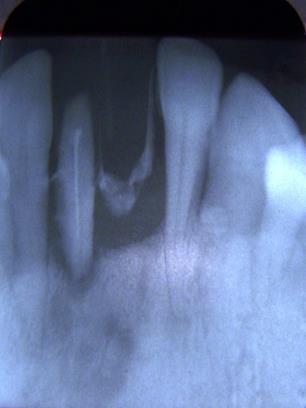 Figure 2: Severe bone loss jeopardizing the prognosis of central incisor.