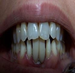 Figure 6: Removal of cantilever bridge with lateral incisor as abutment. a) Lubricate the prepared teeth and the adjacent teeth with Vaseline, b) Prepare resin acryl (e.i., Dentalon plus) (figures 7 and