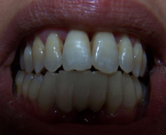 Figure 9: Silicone impression loaded by acryl inserted in the mouth. a) Remove and reseat the restoration until it sets. b) Trim, finish, polish, and cement the bridge (Figure 10)