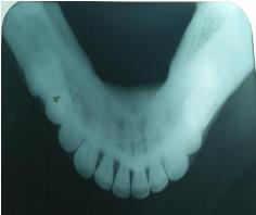 Figure 1: Mandibular tori. On Clinical examination, multiple bony nodules were evident in the lingual region below tongue extending from Canine to first molar bilaterally, in relation to33-36 and