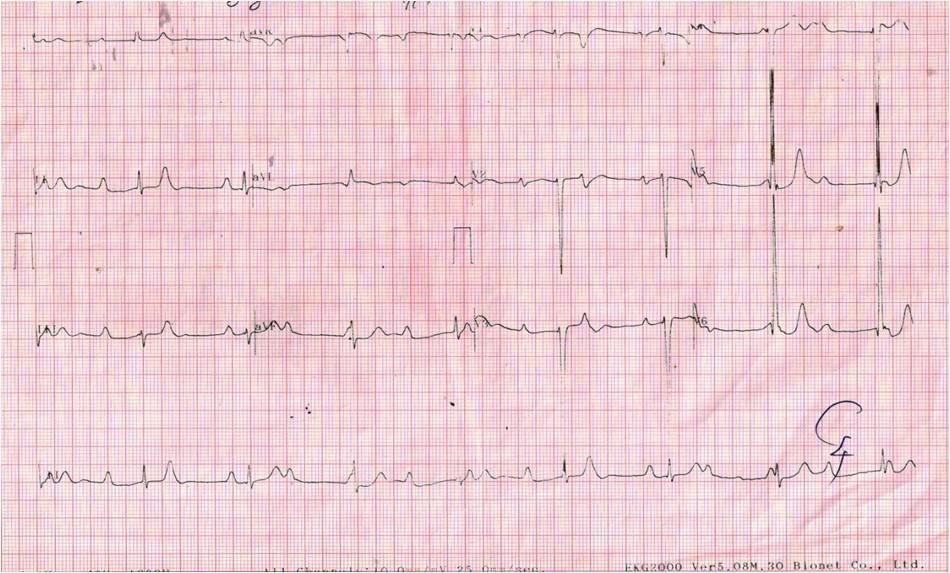 Figure 1: ECG on admission showed third degree AV block with suprahisian escape rhythm.