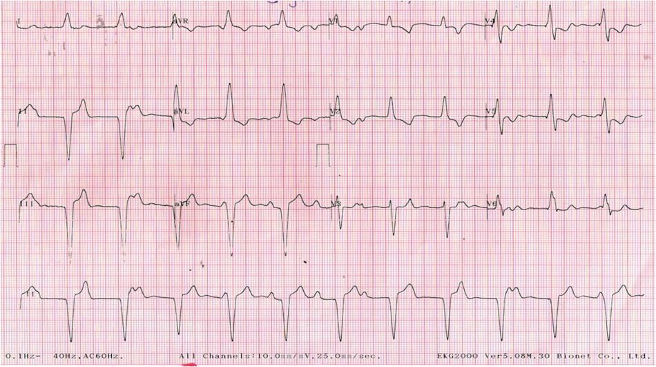 Figure 2: ECG following pacemaker implantation showed QRS axis of around -60o and RBBB pattern in leads V1 & V2 with precordial transition in lead V3.