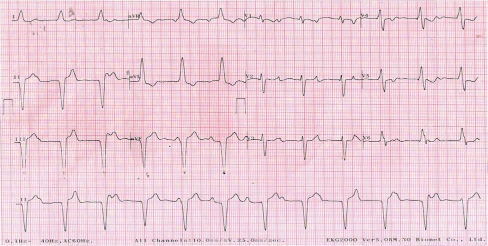 Figure 3: ECG taken with leads V1 & V2 placed 1 inter costal space lower than standard position showed disappearance of RBBB morphology in V1 & v2 leads.