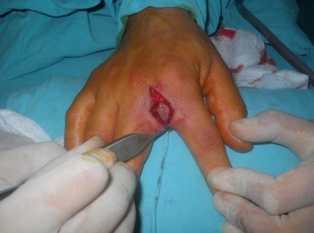 Figure 2: Excision involving unhealthy skin and fistula mouth, hairs coming out from the mouth of fistula at the pensette tip.