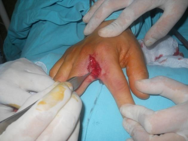 Figure 3: Cystic mass observed to have a fairly smooth boundry and thick capsule.