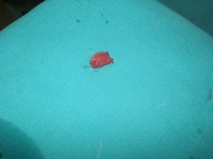 Figure 5: Excised cyst and hair scattered around.