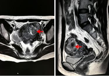 Figure 3: MRI imaging for AVF (A and B): both transverse plane and sagittal plane showed the focus located in the left corner of the uterus and rejected to the serous membrane.