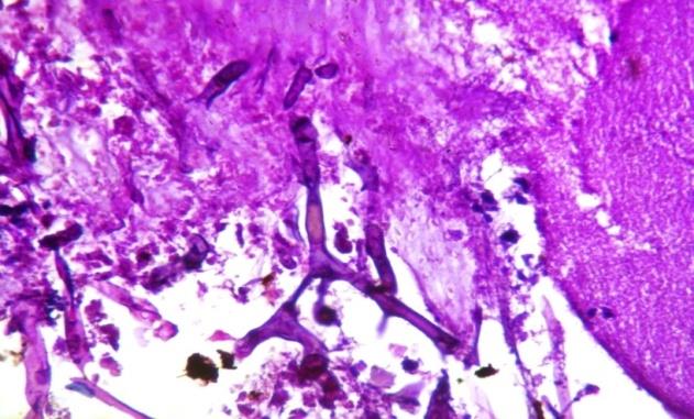 Figure 1: HE section showing pauci septate hyphae suggestive of Aspergillus Flavus (400x). 12 cases (8 from primary cases and 4 from revision cases) had presented with elevated AEC in the preoperative period. Average pretreatment AEC level in the primary and revision cases were 532microg/L and 592microg/L respectively and the difference was not considered significant (0.182). When AEC was correlated for the patients with bone erosion, it has been found that, the mean AEC for primary and revision cases were 570 microg/L and 510 microg/L respectively (P=0.093) as shown in the (Figure 2). In 62 (77.50%) cases (39 primary cases and 23 revision cases), serum IgE was elevated in the preoperative period. The mean pre- operative serum IgE level in primary and revision patients were 850.20IU/ml and 790 IU/ml respectively and the difference was significant (p=0.062) as shown in (Figure 3). On correlating the radiological findings, it has been seen that the mean IgE level in primary patients was 855 IU/ml and for the revision case it was 827 IU/ml although there was no direct correlation between the serum IgE values to that of bony involvement in patients with AFRS. Surgical management with endoscopic techniques was successful for all patients. Aspergillus was isolated in 44(56%) patients (29 primary cases and 15 revision cases) and was the most common etiological agent. When it was correlated with the erosion of bone, 39(88.63%) cases (22 cases primary and 17 cases revision) found positive for Aspergillus (p=0.52) as shown in (Figure 4). The mean SNOT score was 52.5 (for primary cases it was 51 and for the revision cases it was 66) in the preoperative period and when considered patients with bony erosion it was found to be 68.4(59 for primary cases and 62.75 for revision cases) and the difference was found insignificant (p=0.148) as shown (Figure 5). No statistical co-relation was found between KOH mount and serum total IgE and wit the preoperative CT scan findings. There was no significant intraoperative complications encountered in the current study except 1 patient who had periorbital swelling and 3 patients had postoperative nasal bleeding which were managed conservatively in the postoperative period.