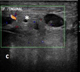 Figure 1: Ultrasound of a 25-year-old female with abdominal actinomycosis. Findings: (a,b): Longitudinal and transverse transabdominal B-mode ultrasound images through the right iliac fossa and inguinal region demonstrate complex heterogeneous collection involving the right iliopsoas muscle (asterisks). (c): Transverse transabdominal color Doppler ultrasound image of the same area shows increased regional flow (asterisks). Technique: US (Philips iU22), linear transducer, 12 MHz. Subsequent unenhanced computed tomography (CT) scan of the abdomen and pelvis revealed an ill-defined, inflammatory soft-tissue mass in the right lower quadrant involving the cecum and invading the adjacent iliopsoas and lower anterior abdominal wall muscles. The mass