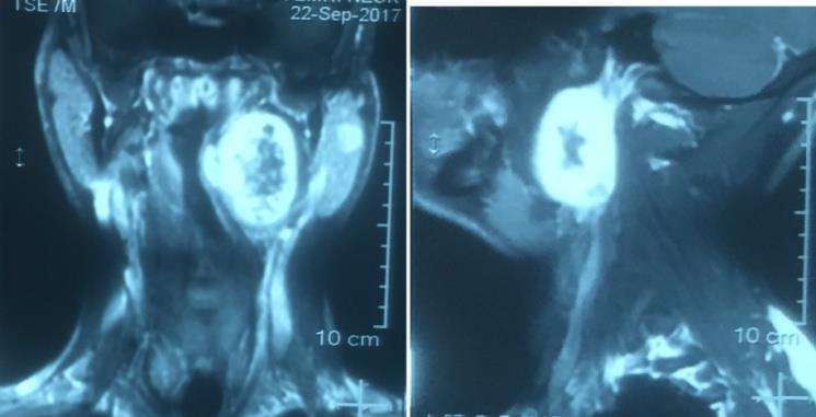 Figure 1: Contrast enhanced MR scan showing (L) intensely enhancing parapharyngeal mass. Differential diagnoses kept in mind were: Thyroid and parapharyngeal space tumor both as separate entity, Thyroid or nasopharyngeal carcinoma with parapharyngeal space (PPS) metastasis. After thorough clinical and radiological evaluation patient underwent (R) hemithyroidectomy with (L) PPS tumor excision via transcervical approach (Figure 2). Specimen was sent for histopathological evaluation and came out as (L) parapharyngeal mass consistent with schwannoma and (R) hemithyroidectomy consistent with Hurthle cell carcinoma (minimal invasive). Patient underwent completion thyroidectomy and final histopathology came out as colloid goitre with focal hurthle cell changes. Patient is in regular follow up on thyroid replacement therapy (100 μg thyroxine daily) and doing fine without any complaints.
