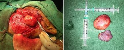 Figure 2: Intraoperative and postoperative pictures of specimen (both PPS tumor and thyroid.