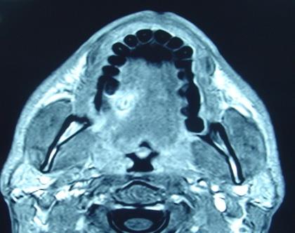 Figure 1: Nuclear Magnetic resonance of the lesion in the right sided tongue.