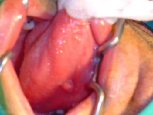 Figure 3: Intraoperatorie view of the fish bone (arrow).