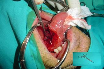 Figure 4: The fish bone near to a forceps.