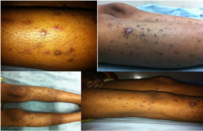 Figure 1: Per abdomen examination showed single live intra-uterine fetus of 32 weeks with cephalic presentation with mild contractions. Patient received steroid cover for fetal lung maturity. Patient’s high vaginal swab and urine culture and sensitivity showed no growth, liver function tests were normal. Dermatological consultation was sought and she was given anti-histaminics. Local steroid were not given due to presence of occasional pustules. The lesion as well as the associated itching did not respond. So after 1 week of treatment, she underwent biopsy from skin lesion. She was given antibiotic ampicillin in view of her pustules (after collecting culture report of pus which showed growth of staphylococcus sensitive to ampicillin). But the patient went in spontaneous preterm labour and delivered 1.8 kg male baby at 33+2 weeks. The histopathology report was collected post- partum, showed Perforating Folliculitis. The lesions and pruritis gradually resolved in post-delivery period. The patient was discharged along with the baby after 2 weeks.