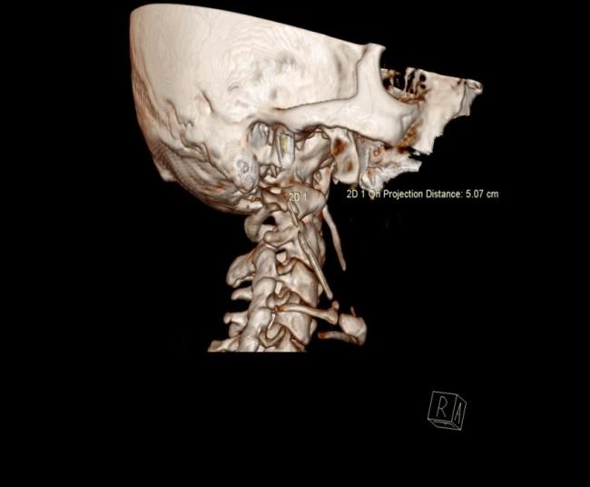 Figure 1: CT 3D reconstructed VRT image: Bilateral elongated calcified stylohyoid ligaments. The right side measures 5cm (arrow).