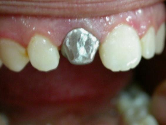 Figure 4: Try in framework for post crown. After shade selection the stratification of ceramics was performed. In the clinic, the metal ceramic post crown was tried again to verify esthetic, static, functional occlusion and phonation. It was cemented using adhesive cement (Figures 5 & 6). The cement was spinned into the canal with a Lentulo Spiral and the inner surface of the post crown and post are coated with the cement and placed in the canal.