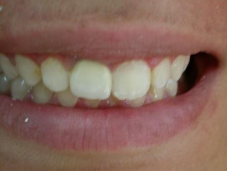 Figure 6: Extra-oral view after adhesive cementation with acceptable esthetic outcome.