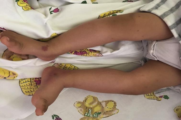 Figure 1: (photo. Taken with parents permission): Initial presentation of the child with purpuric rash and edema of lower limbs. Laboratory workup showed normal complete blood count, coagulation profile, urine microscopy and complements: CBC: Hb 11.5 g/dL, WBC 12.3 109/L, Platelet 509 109/L, ESR 51, C3 1504 (820-1850), C4 345 (150-530), Coagulation profile: PT 9.6 s, APTT 41.4 s, TT15.10s, INR 0.9 The decision was to admit the child with impression of Acute Haemorrhagic edema of infancy. During his admission; the child was doing well, remained afebrile. The rash and edema started to resolve by the second day of admission. He was discharged with minimal edema of upper and lower limbs. Patient was reviewed two weeks after discharge as outpatient visit. He was asymptomatic, active and all skin lesions and limbs edema has resolved (Figure 2).