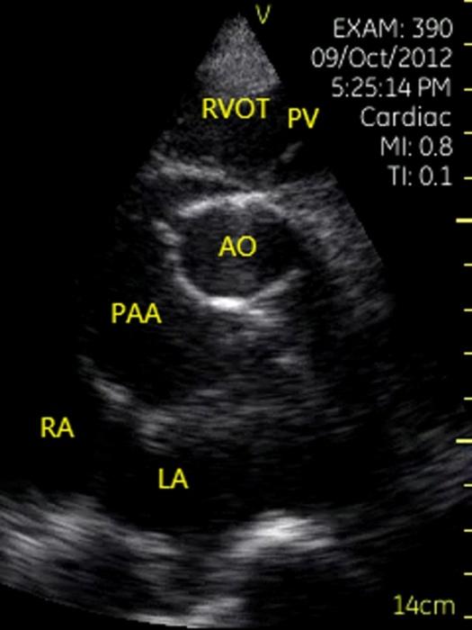 Figure 11: Rupture of left ventricular free wall. Apical four-chamber view showed a large amount of thrombus filled in whole heart chamber.