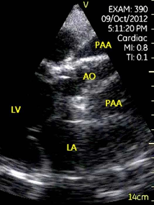 Figure 12: Left atrial thrombus. Left: Parasternal short-axis view of aorta showed a small thrombus on the basal of left atrial wall which closed to the interatrial septum and posterior wall of the left atrium. Middle: Trans esophageal echocardiography showed a thrombus in the left atrium. Right: The thrombus was confirmed by CT (arrow).