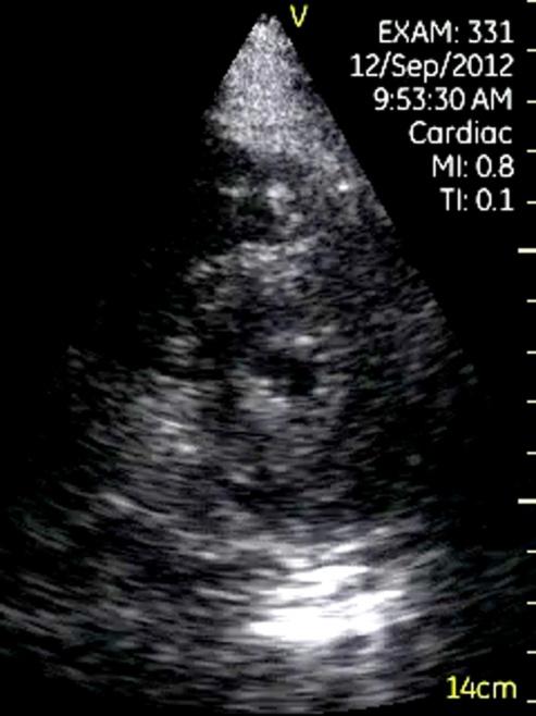 Figure 2: Apical hypertrophic cardiomyopathy. Left: Parasternal short axis view at apical level showed a significant left ventricular hypertrophy in the apical level; Right: Apical four chamber view.