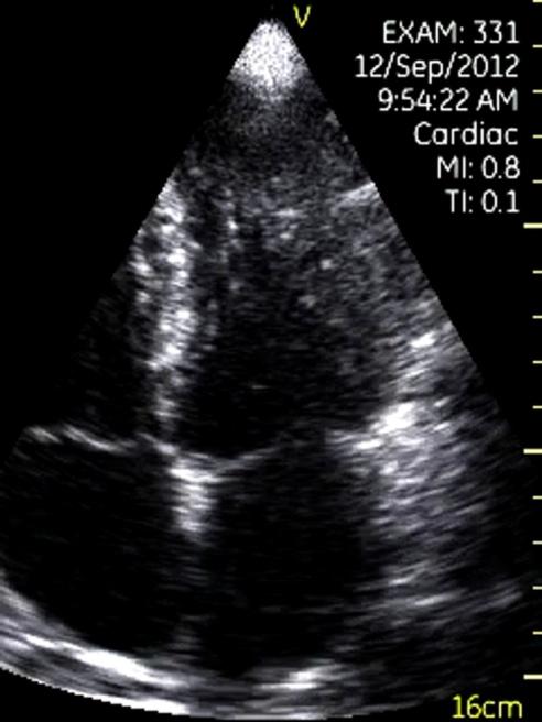 Figure 3: Vegetation in mitral valve. Left: There was a small vegetation on the anterior mitral leaflet in parasternal left ventricular long-axis view. Right: Color flow imaging showed significant mitral regurgitation (MR). LV= left ventricle, Veg= vegetation.