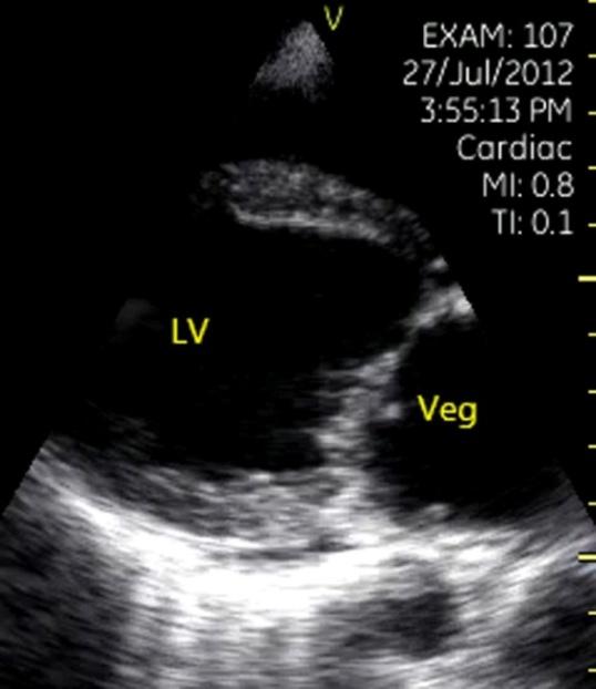 Figure 4: Mitral prolapse. Apical four chamber view showed significant mitral prolapse on posterior leaflet.
