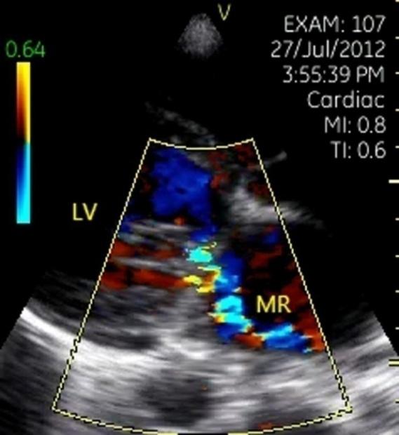 Figure 5: Paravalvular leaking after prosthetic mitral valve replacement. Color flow imaging showed a paravalvular leaking (arrow) in the parasternal left ventricular long- axis view.